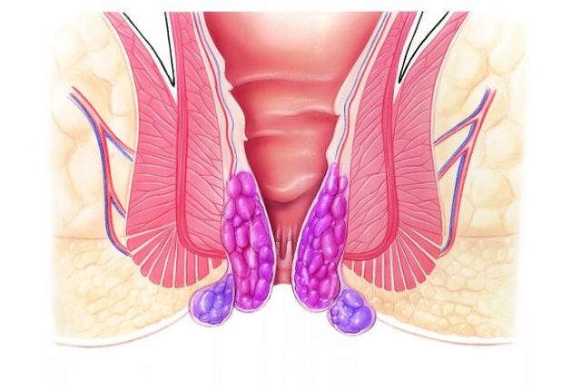 Gelararex este introdus rectal folosind un aplicator